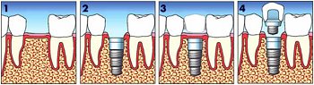 impianto dentale_2 - dentista piazza